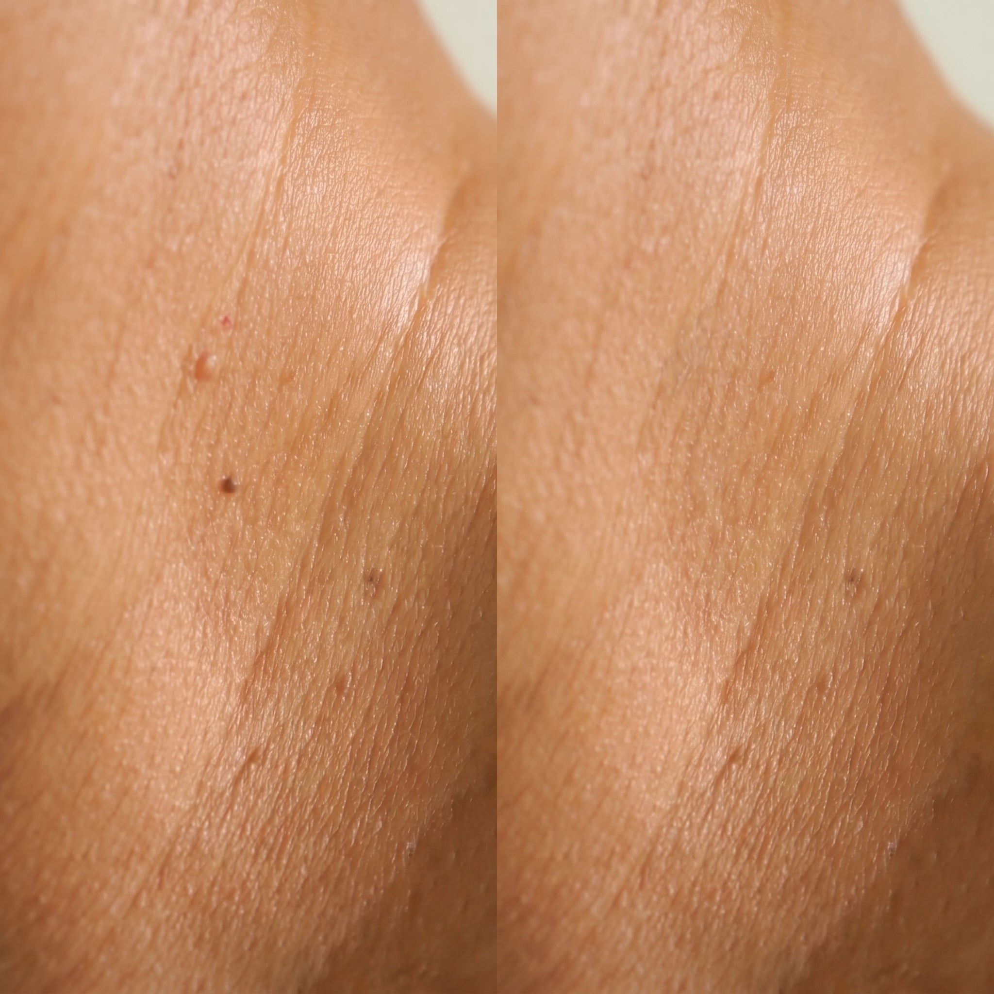 skin-tag-before-and-after-castor-oil